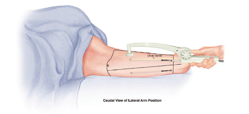 Radiofrequency-Assisted Liposuction Compared with Aggressive Superficial, Subdermal Liposuction of the Arms: A Bilateral Quantitative Comparison