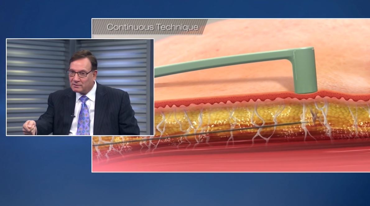 DR DIBERNARDO TALKS ABOUT INMODE’S BODYTITE AND FACETITE ON NEWS12NJ