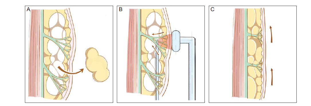 The Efficacy and Safety of Subcutaneous Radiofrequency After Liposuction: A New Application for Face and Neck Skin Tightening