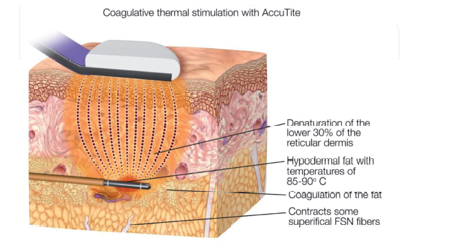 Internal and External Radiofrequency Assisted Lipo-Coagulation (RFAL ...