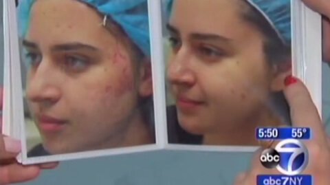 FRACTORA ACNE TREATMENT FEATURED ON ABC NEWS